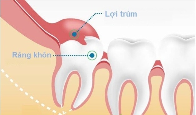 Tìm hiểu khi nào cần nhổ răng khôn
