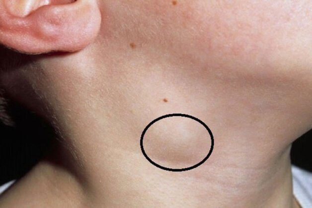 mức độ lây của bệnh lao hạch