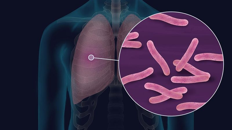 Tiên lượng của bệnh nhân lao màng phổi