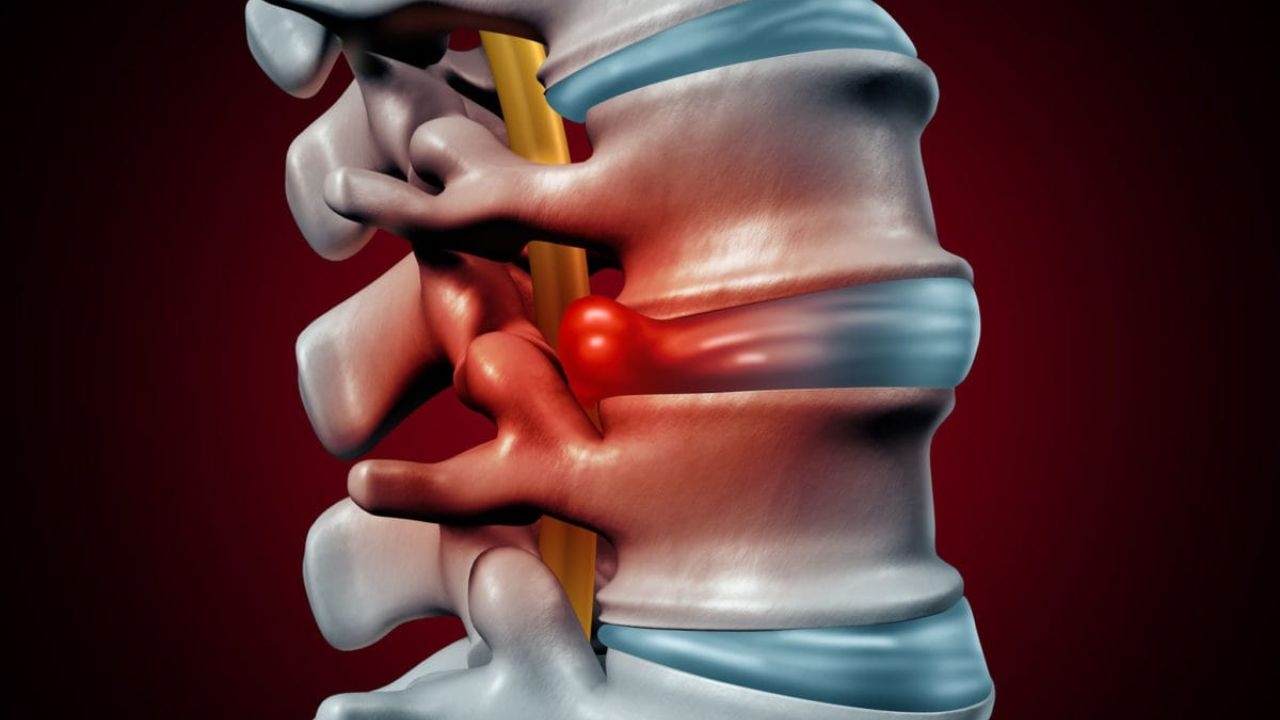 Thoát vị đĩa đệm L3 L4: Nguyên nhân, Triệu chứng và Điều trị