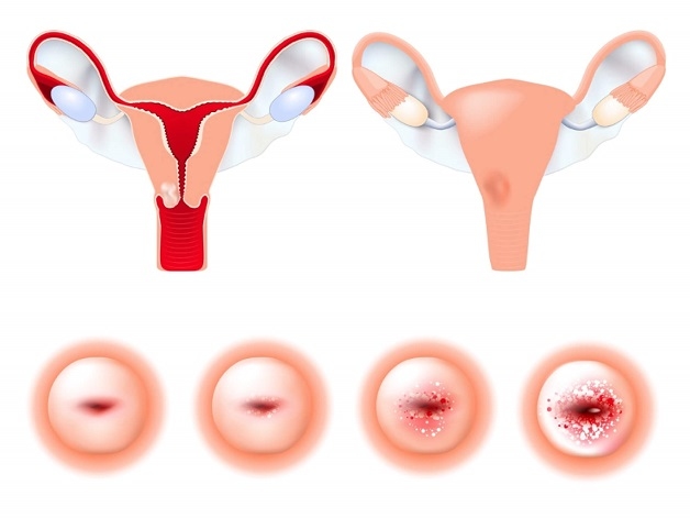 Ung thư cổ tử cung, một trong những bệnh lý ác tính và phổ biến nhất do HPV gây ra, có thể ngăn chặn hoàn toàn bằng cách tiêm vacxin HPV