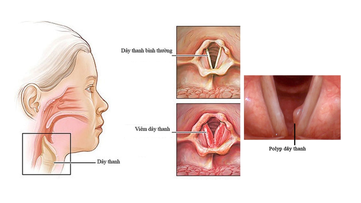 Polyp, viêm dây thanh quản &#8211; Điều trị dễ dàng nhờ TCI