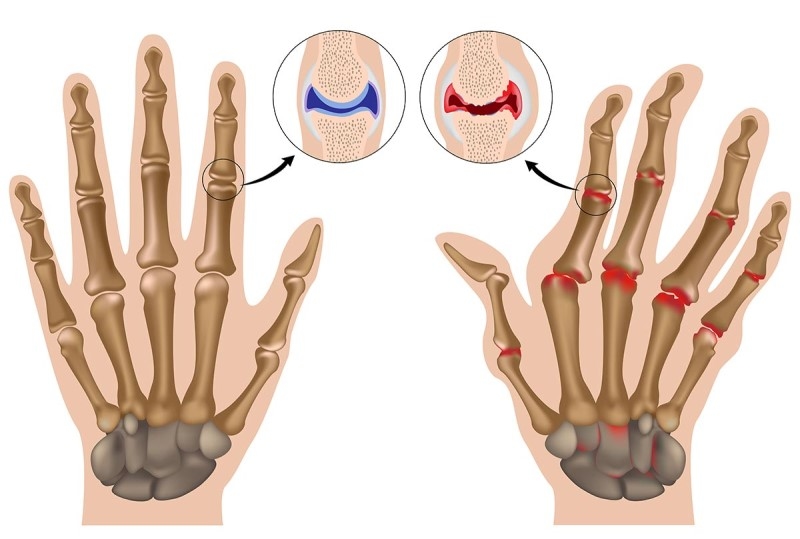 Mục tiêu điều trị cho bệnh nhân viêm khớp dạng thấp