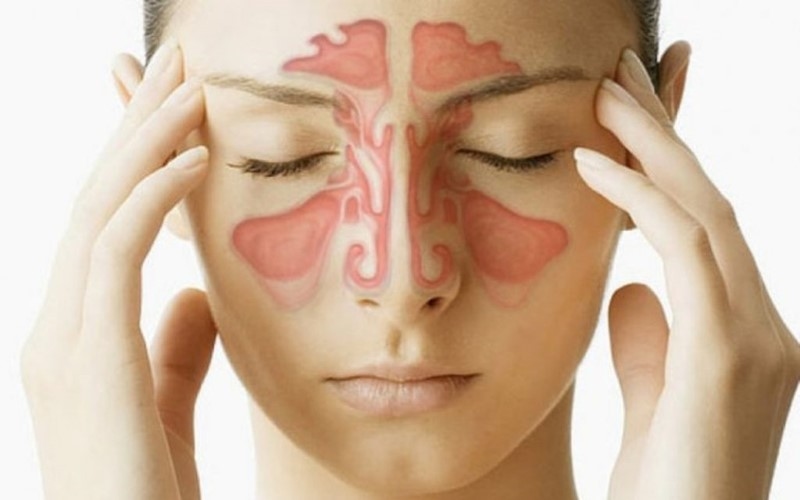 Viêm xoang mạn tính có nhiều biến chứng nguy hiểm
