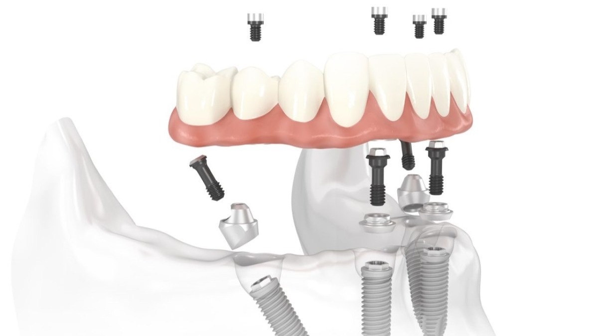 Những lưu ý khi thực hiện kỹ thuật trồng răng Implant
