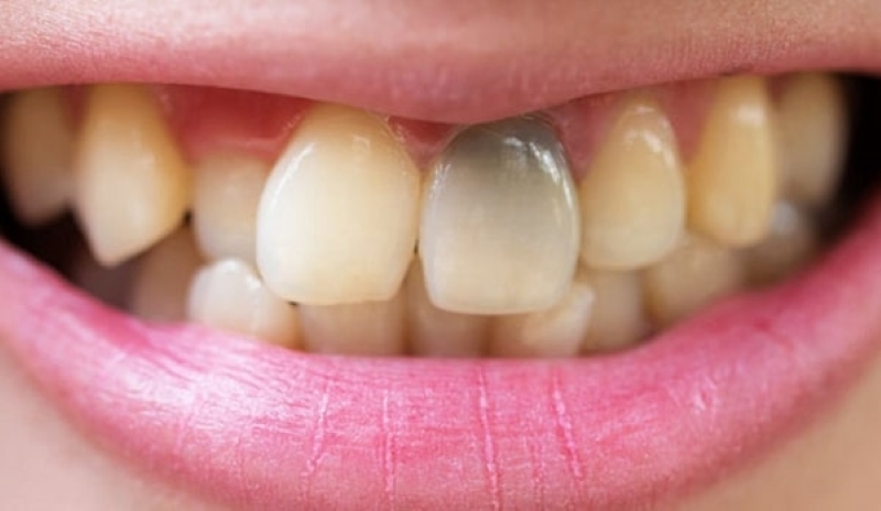 Tình trạng răng cửa bị sâu bên trong