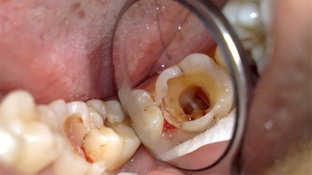 Mức độ nguy hiểm khi bị sâu răng lỗ to