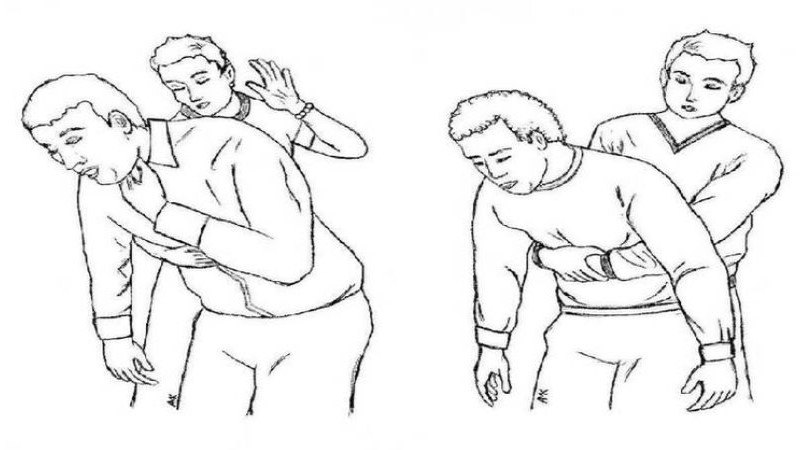 Nghiệm pháp Heimlich cần được thực hiện đúng thao tác và quy trình