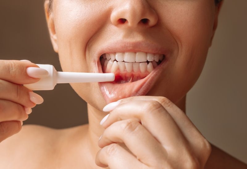 Có nhiều thuốc bạn có thể bôi để đẩy nhanh tốc độ hồi phục nhiệt miệng. Các thuốc bôi nhiệt miệng thường có tác dụng giảm đau, khử trùng.