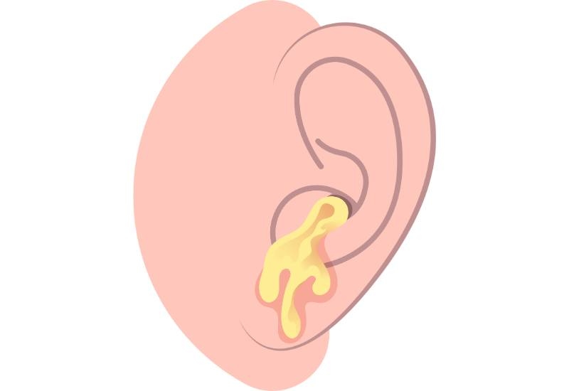 Bệnh viêm tai giữa ở trẻ là tình trạng y tế mà trong đó tai giữa bị viêm.