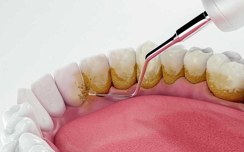 Tình trạng cao răng lâu năm