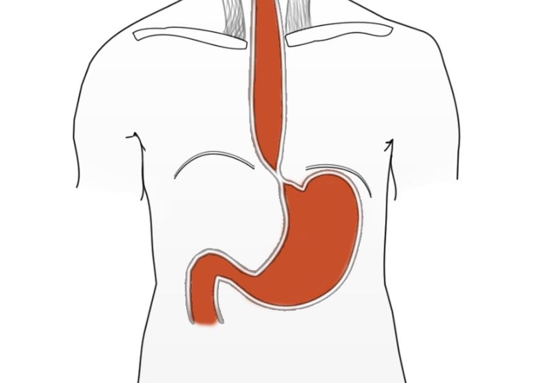 Co thắt tâm vị gây ra tình trạng nuốt nghẹn