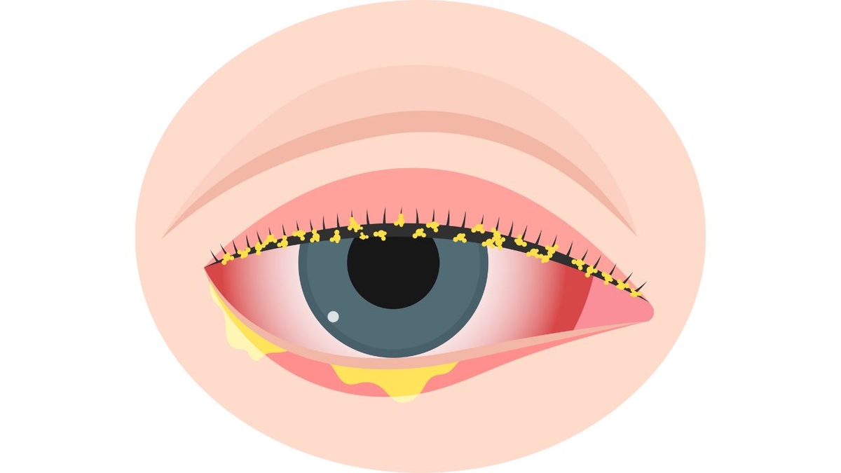 Tổng hợp dấu hiệu đau mắt đỏ: Biết để nhanh chóng xử lý