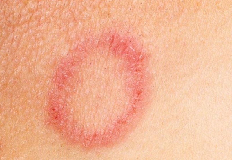 Các bệnh lý có thể sử dụng kem bôi da Soslac G3