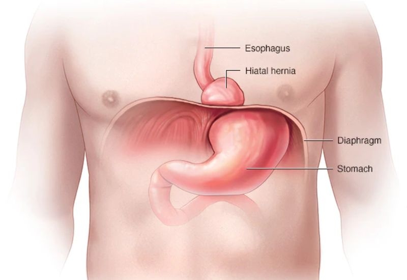 Các bệnh lý gây nuốt nghẹn không phải do trào ngược dạ dày - thực quản
