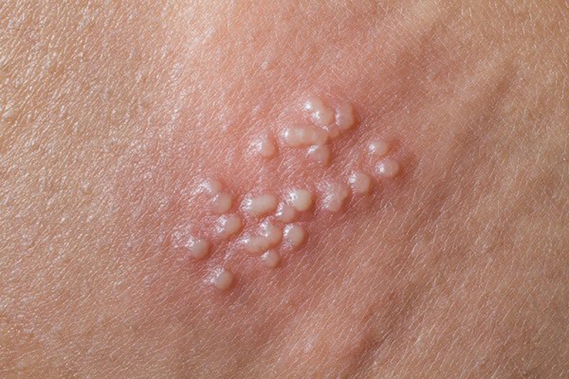 Những bệnh về đường sinh dục có thể ảnh hưởng rất lớn đến chất lượng cuộc sống.