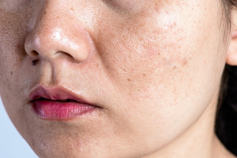 Nám da là vấn đề về da liễu mà nhiều chị em gặp phải.