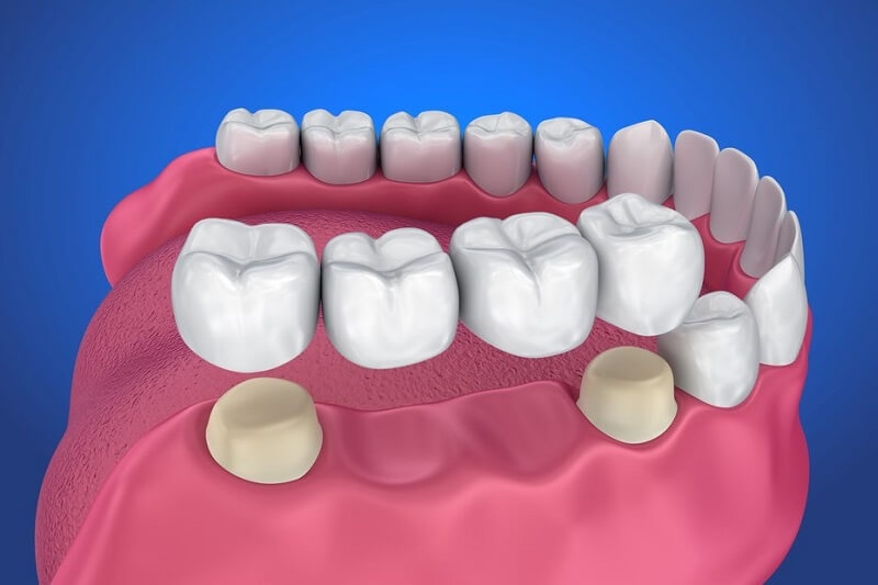 Phương pháp bắc cầu răng sứ cũng là phương án được nhiều người lựa chọn.