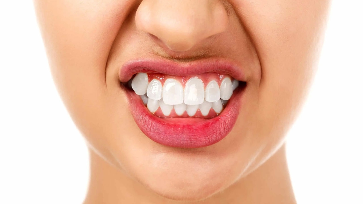 Bọc răng sứ 2 răng cửa bị hô &#8211; Những điều nên biết