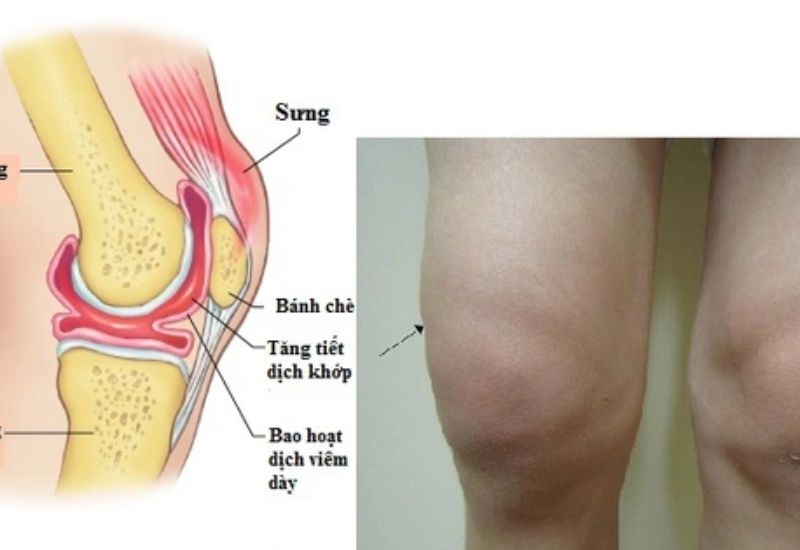 các loại chấn thương phần mềm