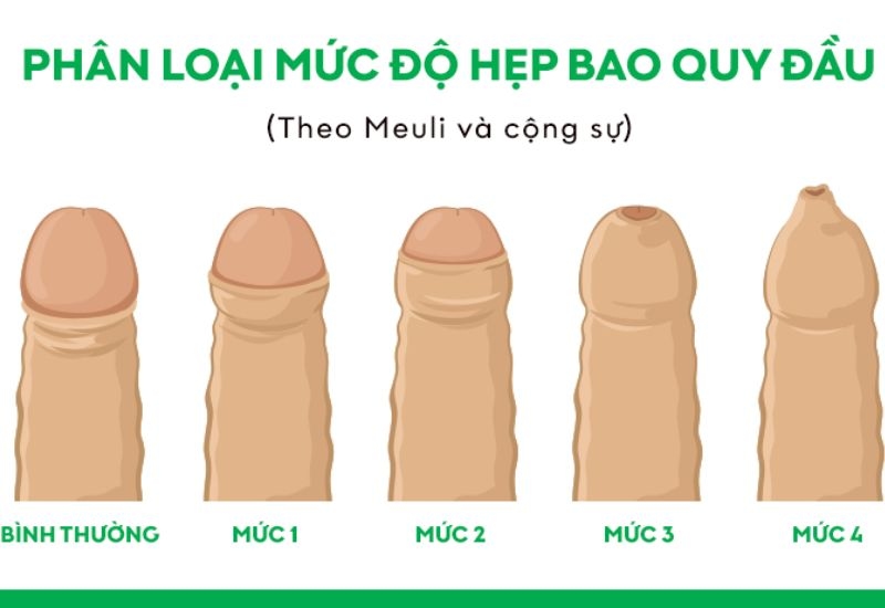 cắt bao quy đầu bị hẹp