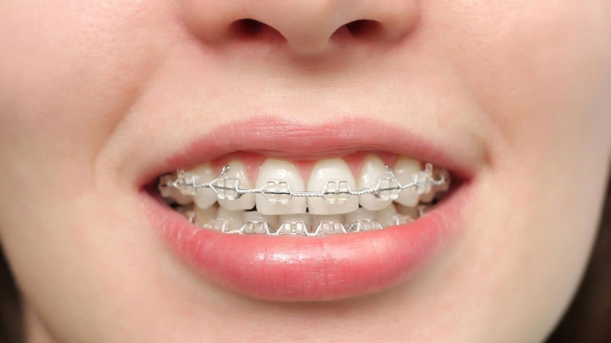 Chỉnh nha niềng răng &#8211; Những điều cần biết trước khi thực hiện