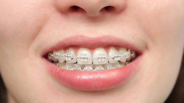 Chỉnh nha niềng răng &#8211; Những điều cần biết trước khi thực hiện