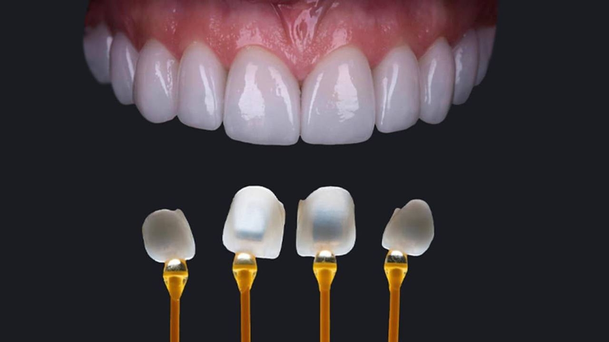 Dán sứ veneer là gì &#8211; Những điều cần biết