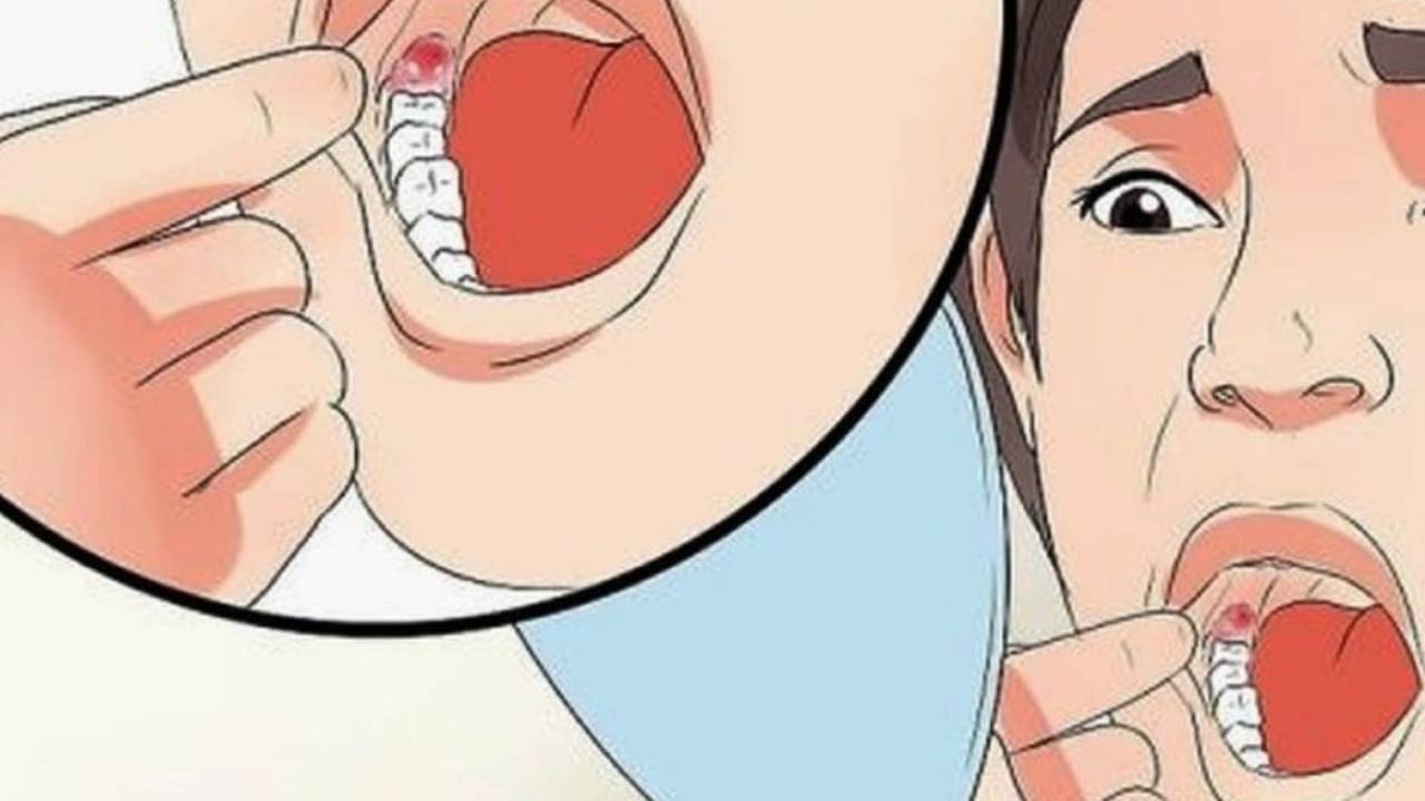 Đau nướu răng trong cùng &#8211; Dấu hiệu của nhiều vấn đề răng miệng