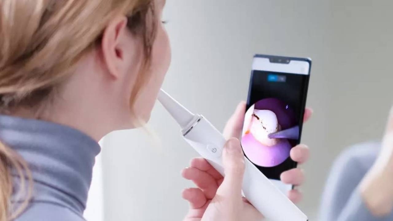 Dụng cụ lấy cao răng tại nhà &#8211; Tiềm ẩn nhiều rủi ro