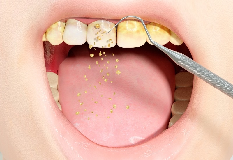 Cao răng là một lớp cứng bám trên bề mặt răng và dưới viền nướu.