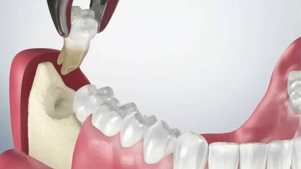 Khi nào nên nhổ răng khôn &#8211; Giải đáp từ bác sĩ