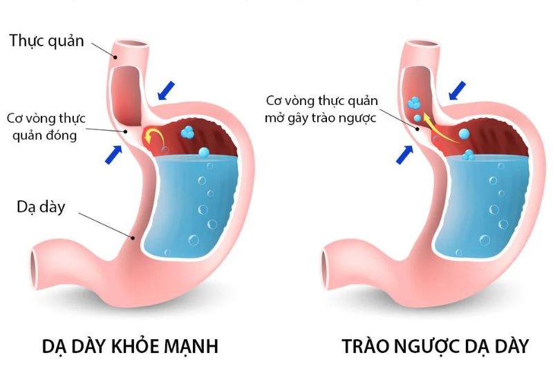 Nguyên nhân gây khó nuốt nước bọt 