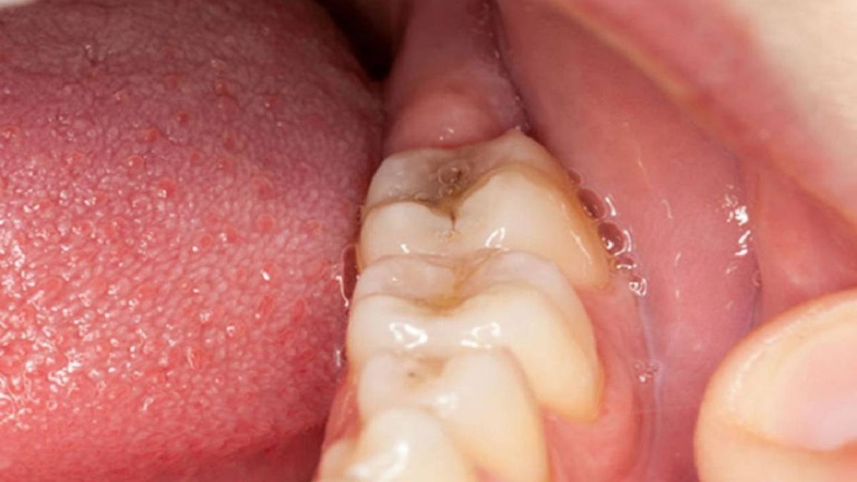 Lợi trong cùng bị sưng &#8211; Nguyên nhân và cách giải quyết