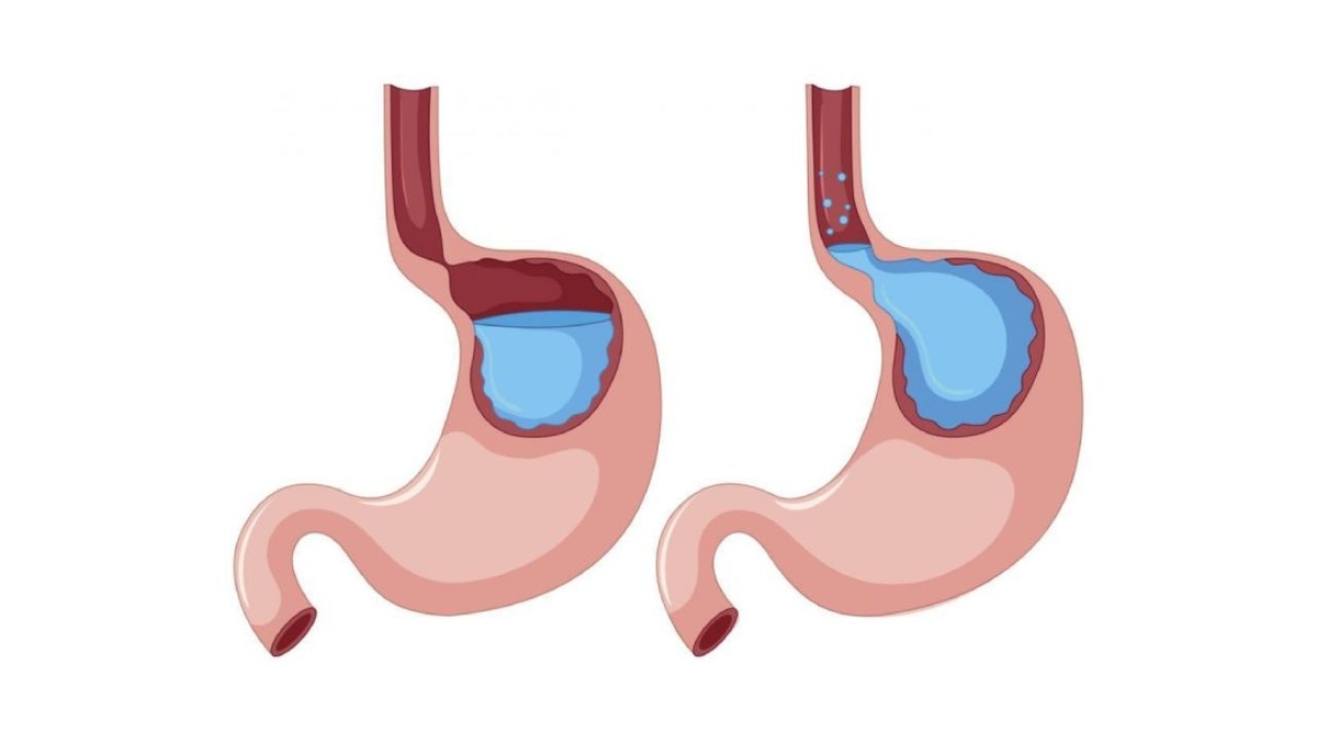 Lý do trào ngược dạ dày &#8211; thực quản, chẩn đoán và điều trị