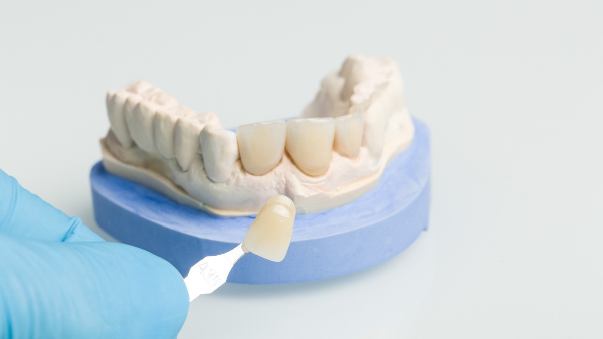 Mặt dán sứ veneer là gì, giải đáp từ chuyên gia