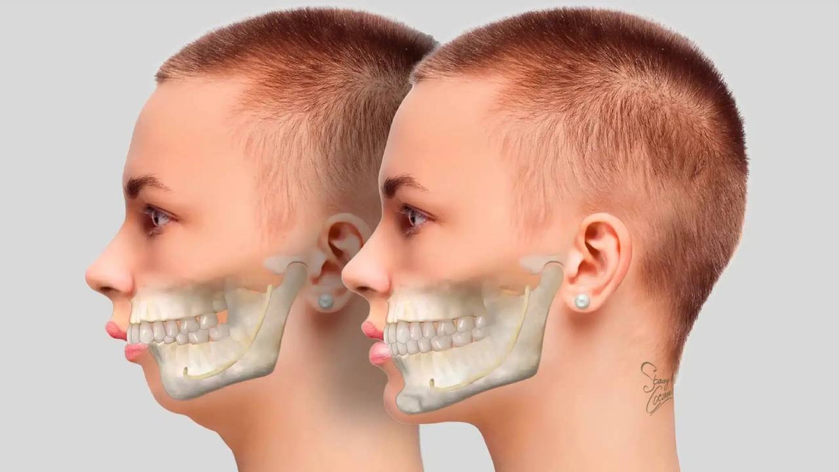 Niềng răng hô mất bao lâu &#8211; Giải đáp từ chuyên gia