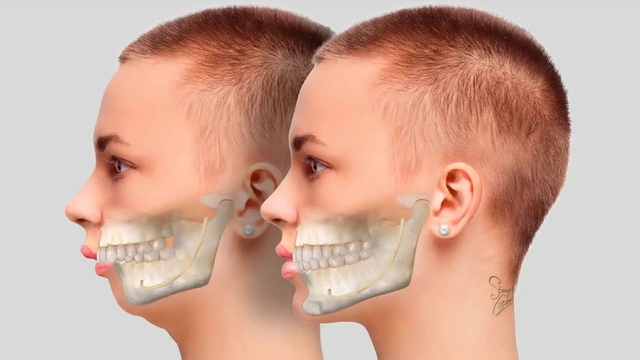 Niềng răng hô mất bao lâu &#8211; Giải đáp từ chuyên gia