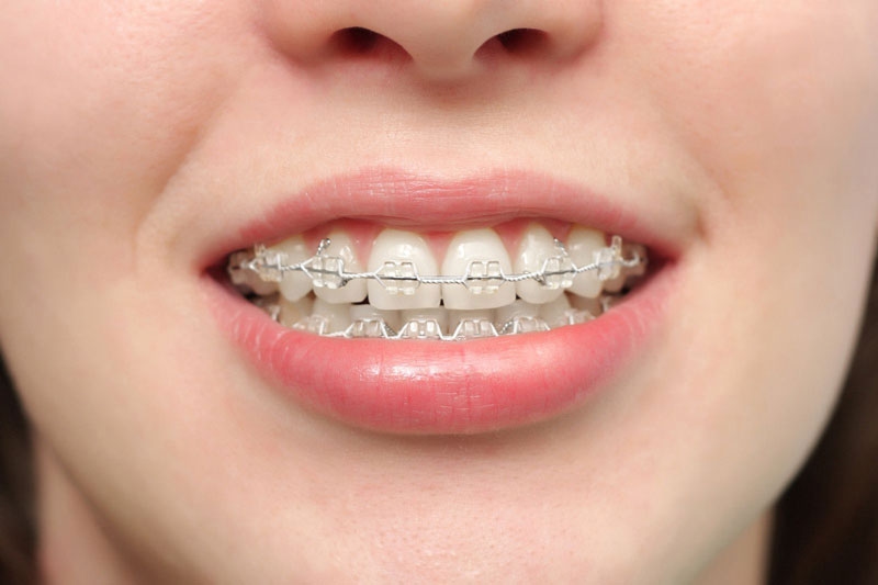 Niềng răng hô mất bao lâu vậy