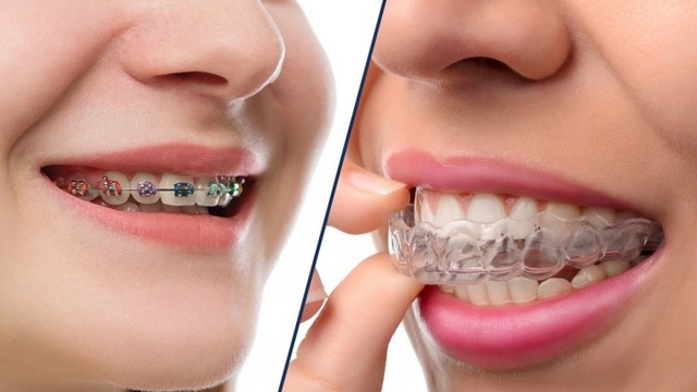 Niềng răng mất bao lâu &#8211; Chuyên gia giải đáp