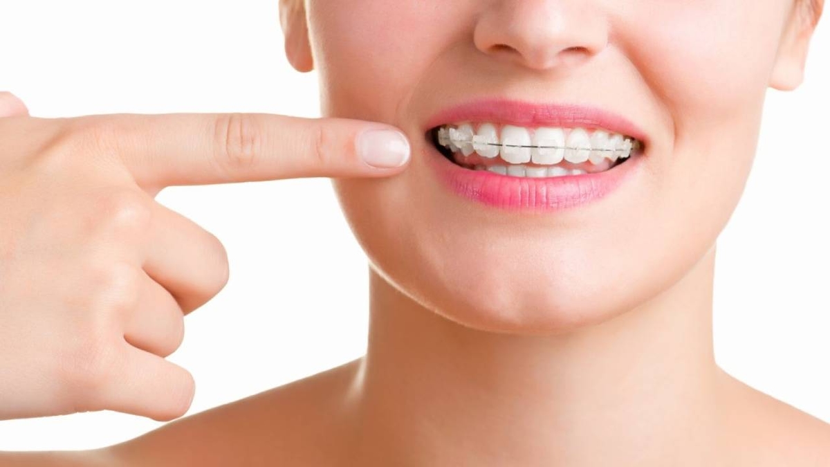 Niềng răng sứ thẩm mỹ &#8211; Những điều cần biết