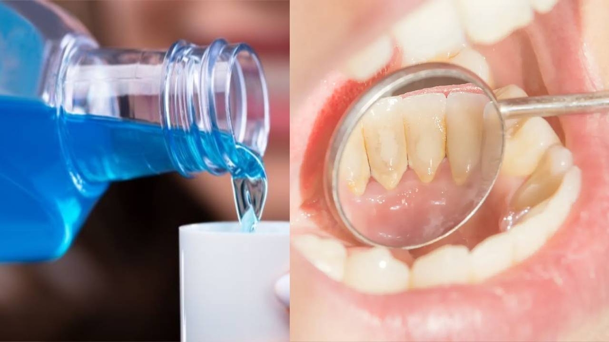 Nước súc miệng lấy cao răng &#8211; Những sự thật bạn cần biết