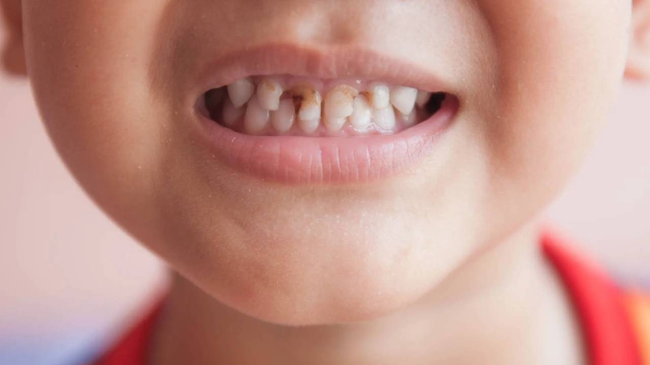 Răng cửa bị sâu: &#8220;Khắc tinh&#8221; của nụ cười rạng rỡ