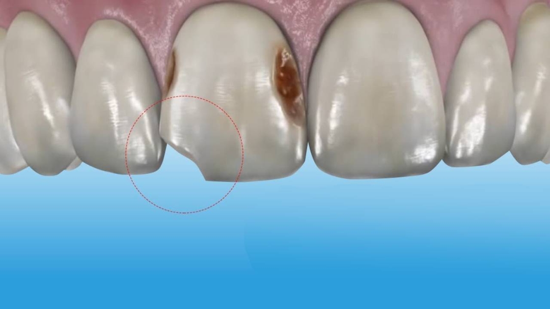 Răng cửa bị sâu và mẻ &#8211; Phòng ngừa và xử lý