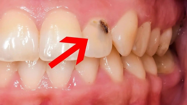 Sâu răng cửa ở người lớn &#8211; Vấn đề không hiếm gặp