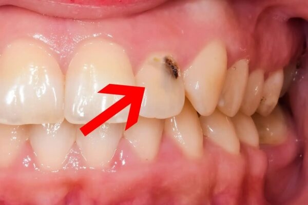 Sâu răng cửa gây ra những vấn đề về thẩm mỹ rất lớn.