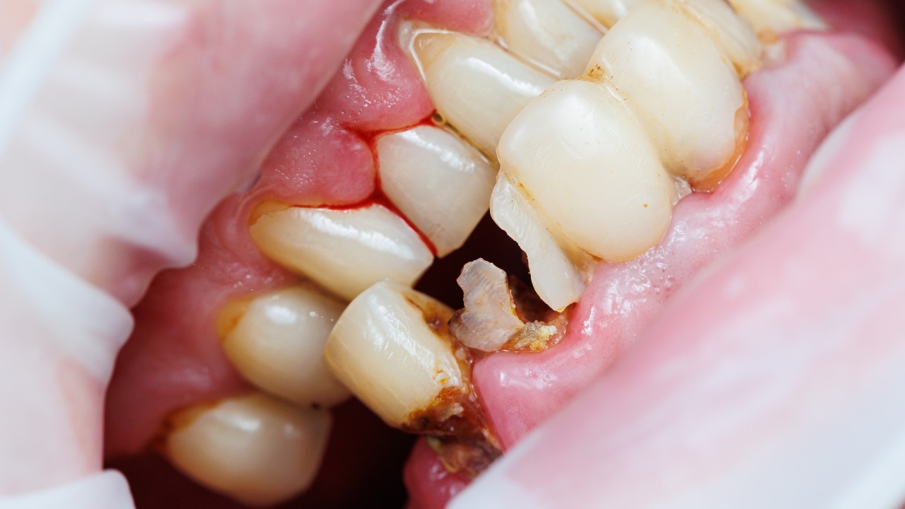 Sâu răng cửa phải làm sao: Cách điều trị theo mức độ nặng &#8211; nhẹ