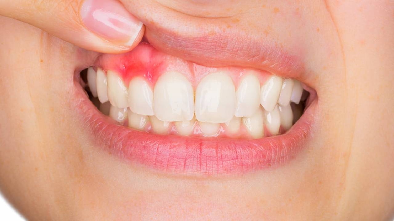 Sử dụng thuốc trị viêm nướu răng hiệu quả, an toàn