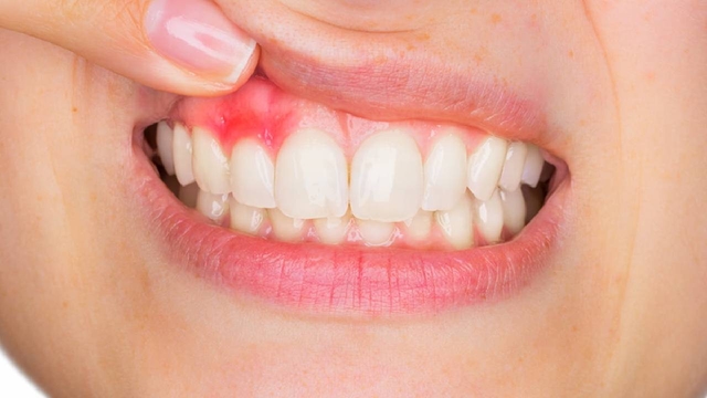Sử dụng thuốc trị viêm nướu răng hiệu quả, an toàn