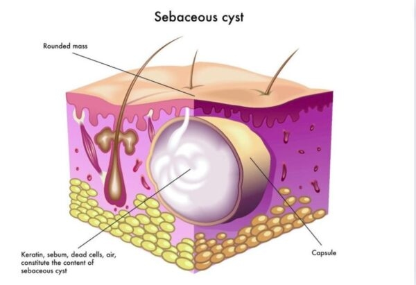 Đặc điểm của u bã đậu